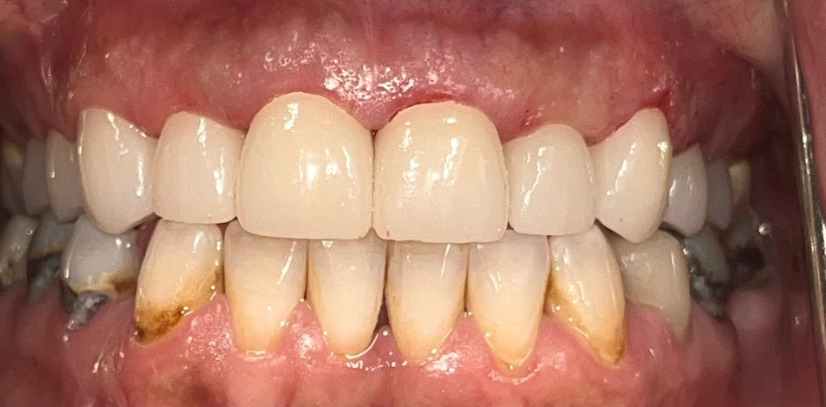 Close-up of a mouth with upper front teeth restored by dental crowns and lower teeth showing signs of staining and gum inflammation.