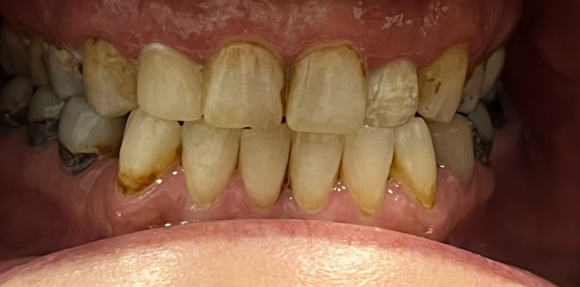 Close-up of discolored and stained lower and upper front teeth with visible tartar buildup.