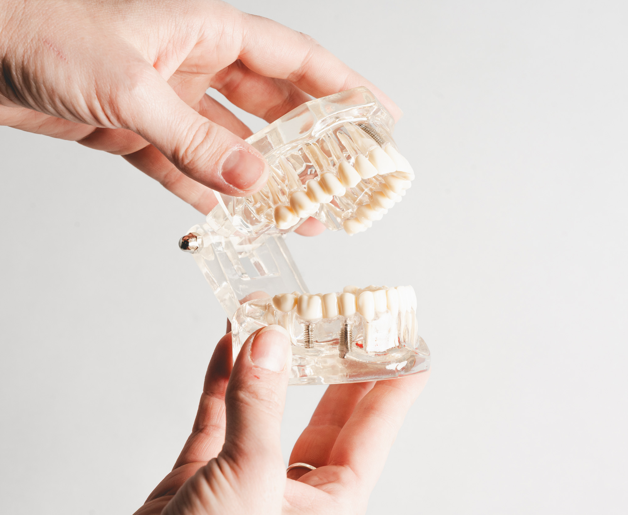 Hands holding a transparent dental model showing teeth and dental implants on a white background.