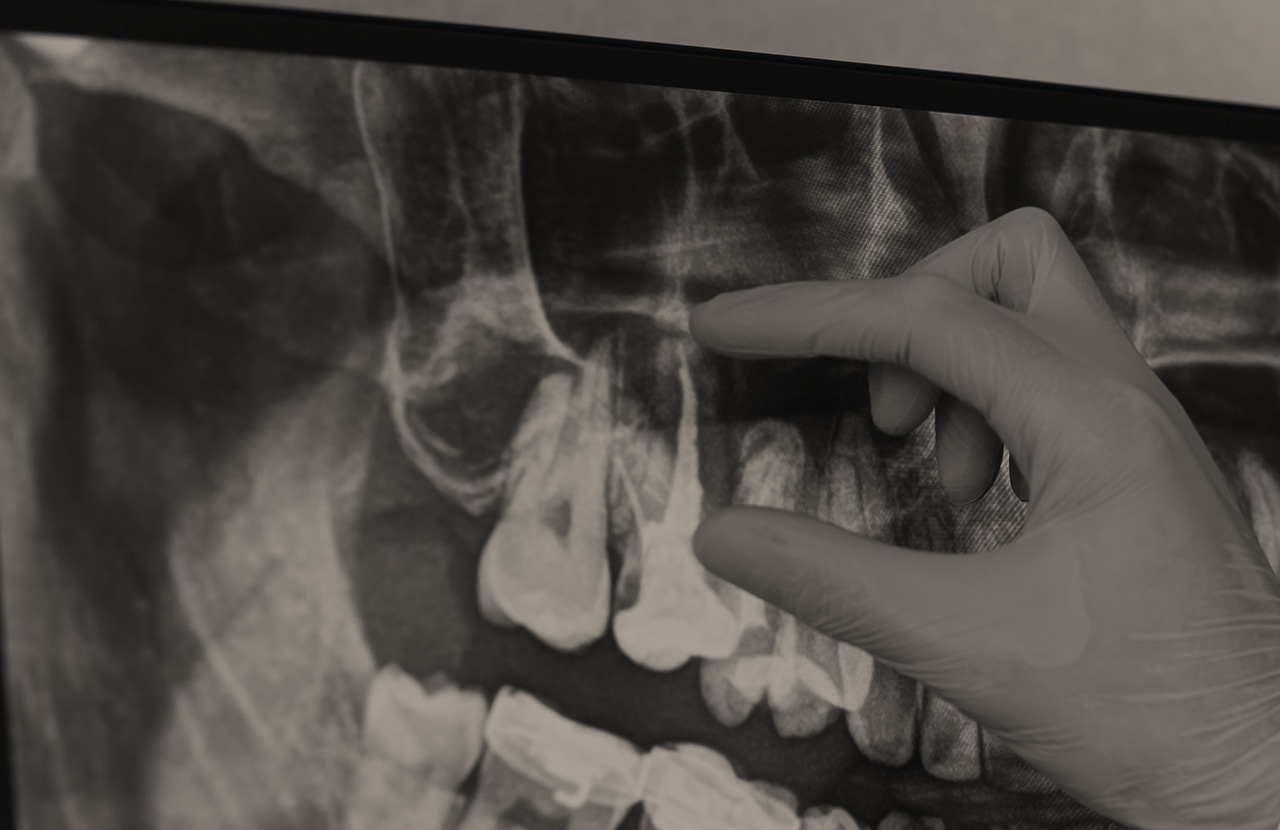 Gloved hand pointing at a dental X-ray focused on molar teeth and roots.