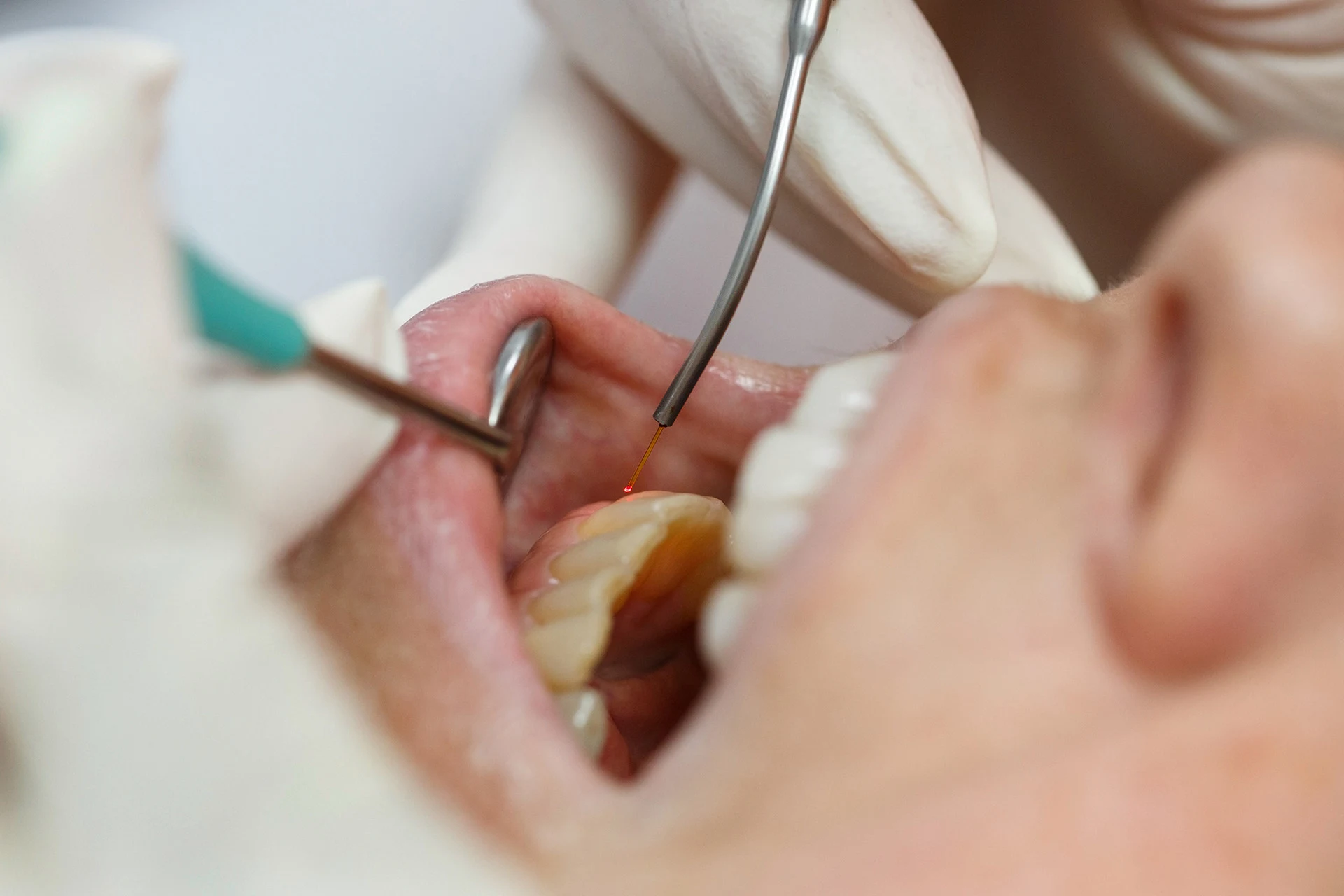 Soft-Tissue Laser Therapy