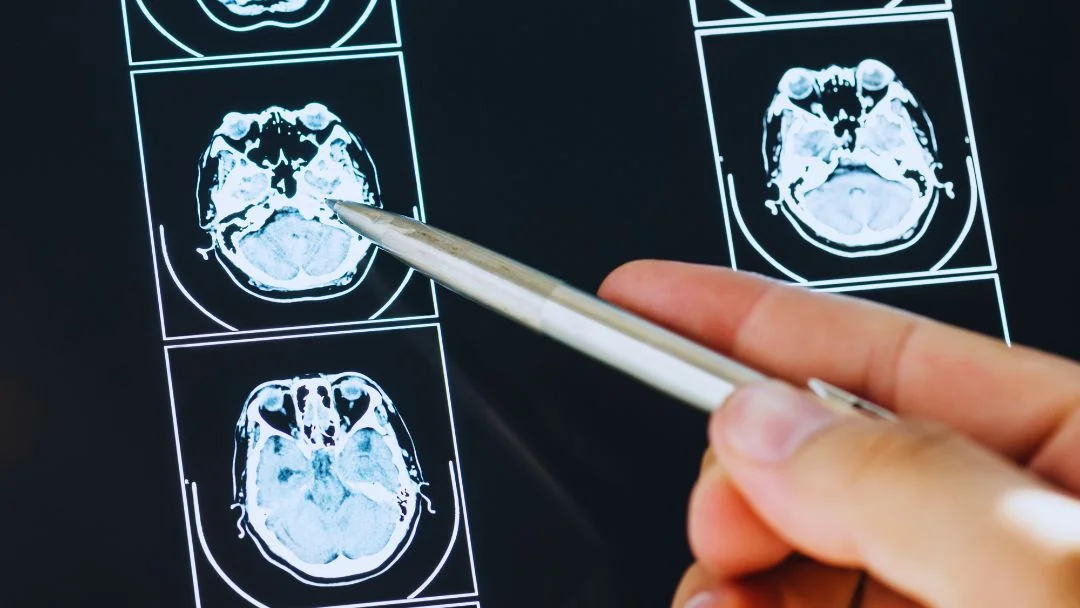 Brain Injury Settlement in Calgary & Alberta: What Fair Compensation Looks Like and How to Prove It
