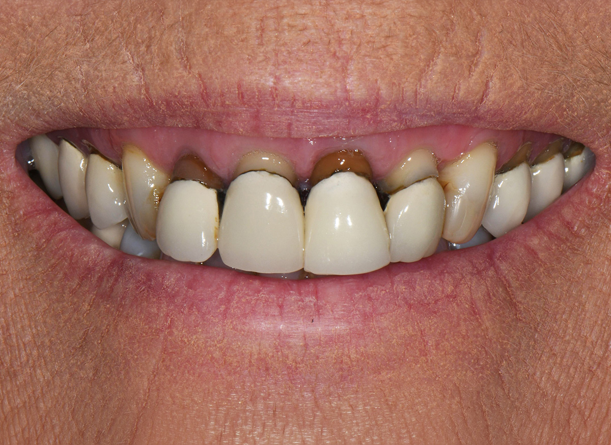 Close-up of a mouth showing teeth with severe discoloration, decay, and dental crowns.