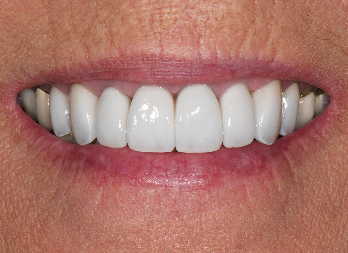 Close-up of a smile showing clean, white, evenly aligned upper teeth and lips.