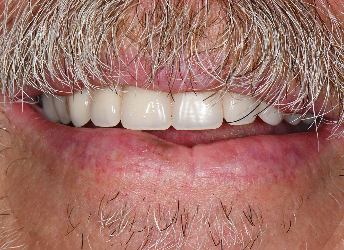 Close-up of a man’s mouth showing white teeth with upper lip covered by a mustache.