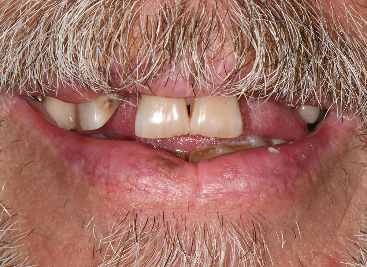 Close-up of a man's mouth with missing, stained, and decayed upper and lower front teeth and a mustache.