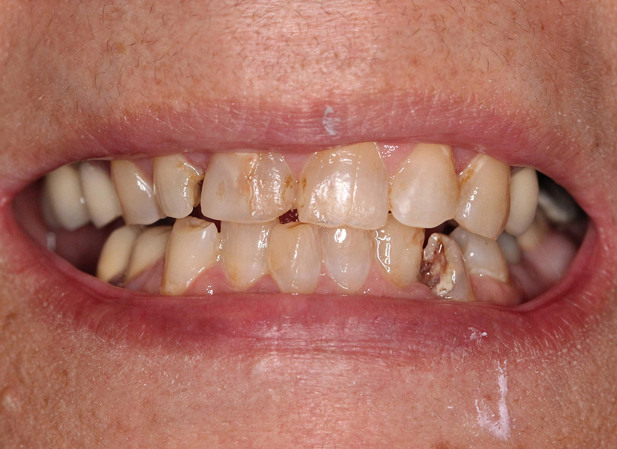 Close-up of a mouth with severely decayed and discolored upper and lower front teeth.