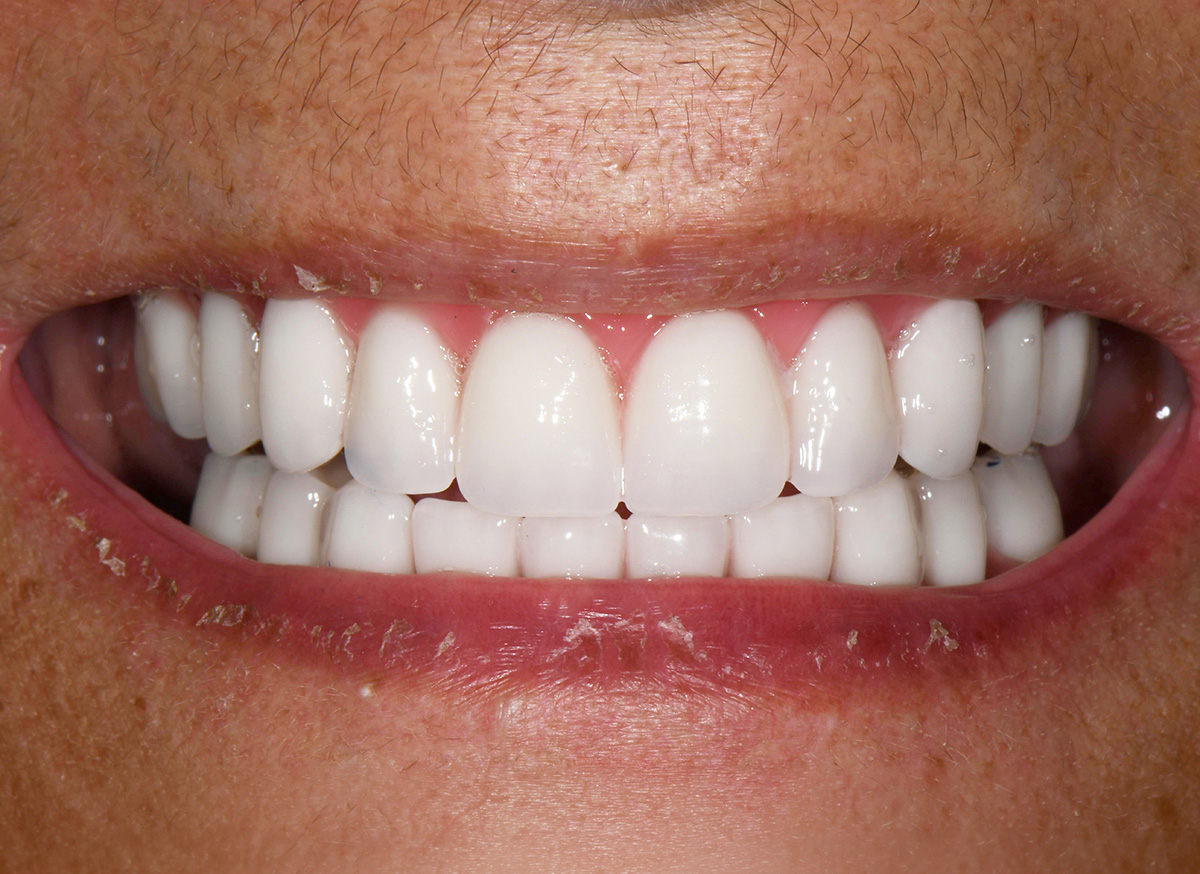 Close-up of a smile showing clean, bright white teeth and dry skin around the lips.