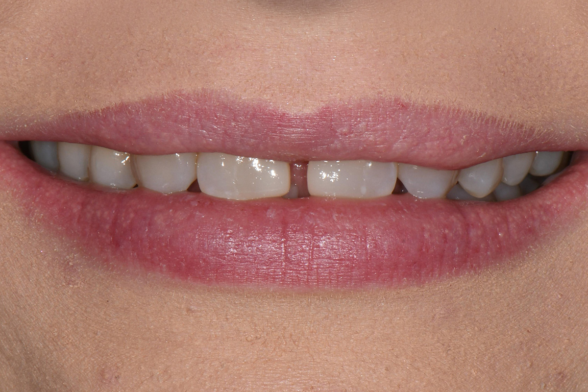 Close-up of a closed mouth with light pink lips and visible upper front teeth, slight gap between two front teeth.