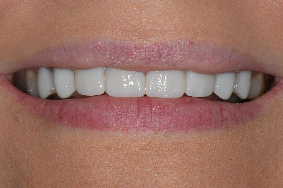 Close-up of a smile with white, even teeth and natural lips.