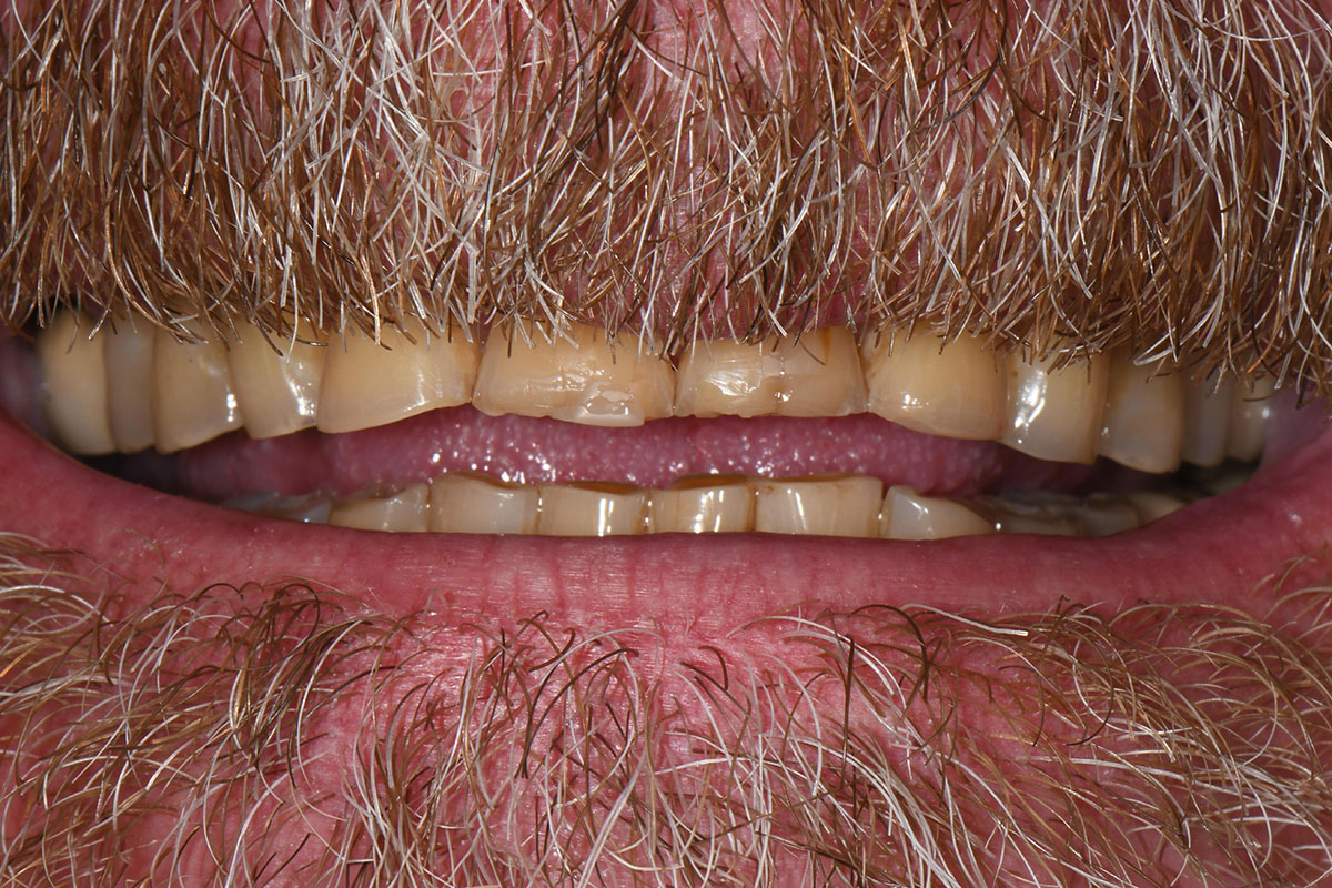 Close-up of stained, chipped front teeth with a mustache and beard above and below the lips.
