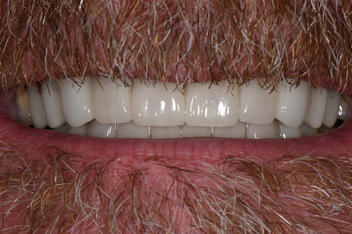 Close-up of a man's mouth with white, straight teeth and brown facial hair.