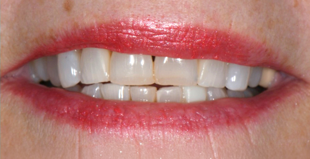 Close-up of slightly uneven teeth with visible plaque stains and lips with worn red lipstick.