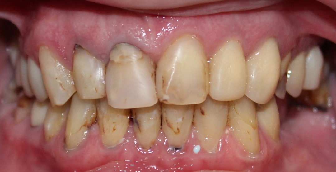 Close-up of upper and lower teeth with visible discoloration, cavities, and plaque buildup.