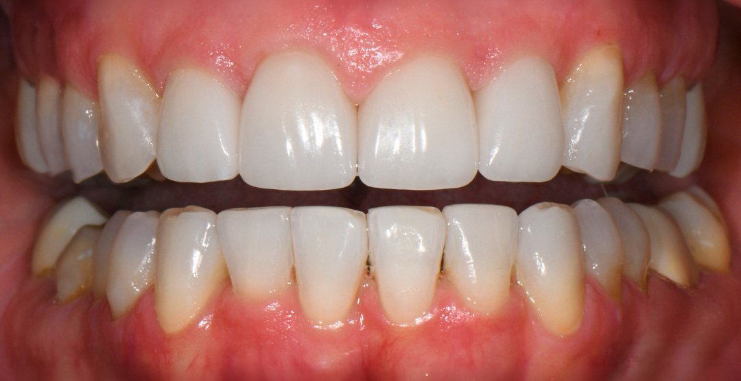 Close-up of clean, healthy upper and lower teeth with pink gums and no visible dental issues.