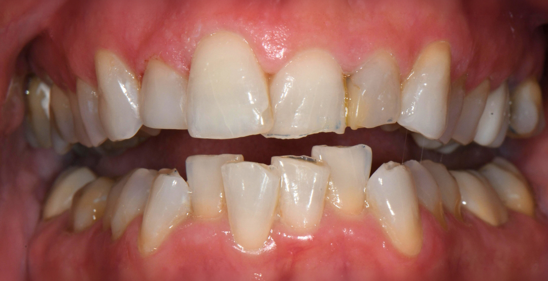 Close-up of upper and lower teeth showing discoloration, chipping, and misalignment.