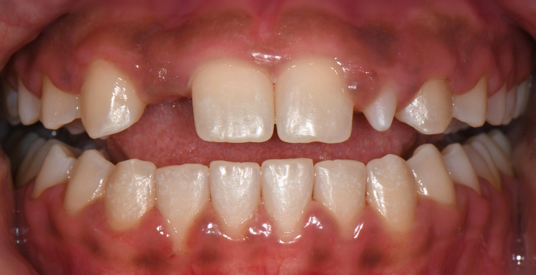 Close-up of upper and lower teeth showing gaps and uneven spacing in a dental arch.