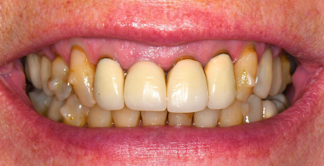 Close-up of teeth showing severe brown plaque buildup and discoloration on upper teeth.
