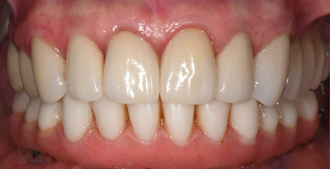 Close-up of healthy, clean, white teeth with pink gums and smooth enamel texture.