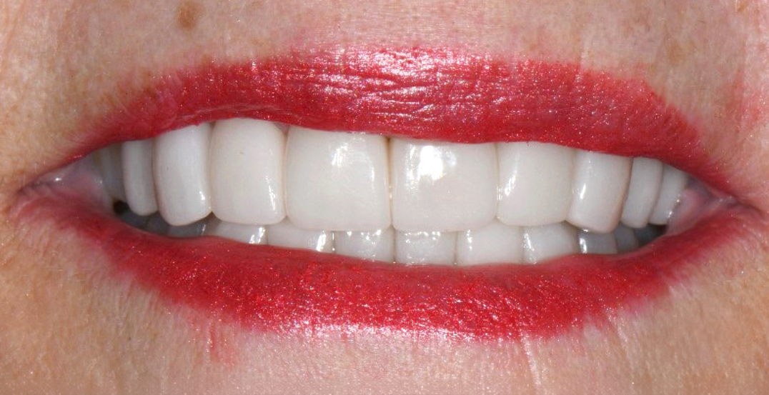 Close-up of a smile with white teeth and red lipstick on lips.