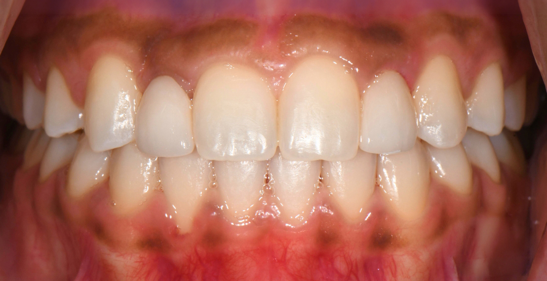 Close-up of healthy upper and lower teeth with visible gums showing slight pigmentation spots.
