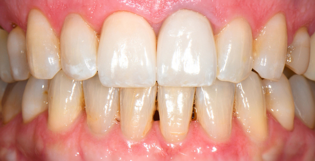 Close-up of upper and lower teeth showing natural color variation and gum tissue.