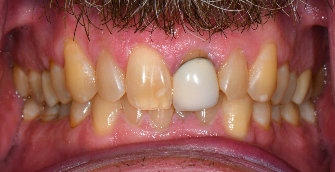 Close-up of person's upper and lower teeth showing one white dental crown among natural teeth.