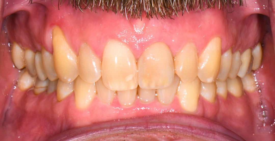 Close-up of a person's smiling mouth showing upper and lower teeth and part of a mustache.