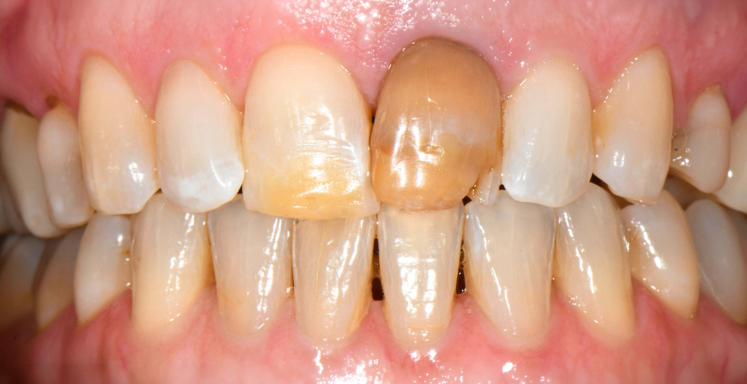 Close-up of upper and lower front teeth with one upper front tooth noticeably darker and discolored.