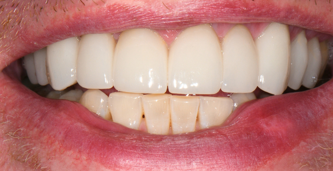 Close-up of a smile showing white upper teeth and slightly discolored lower teeth with lips and facial hair.
