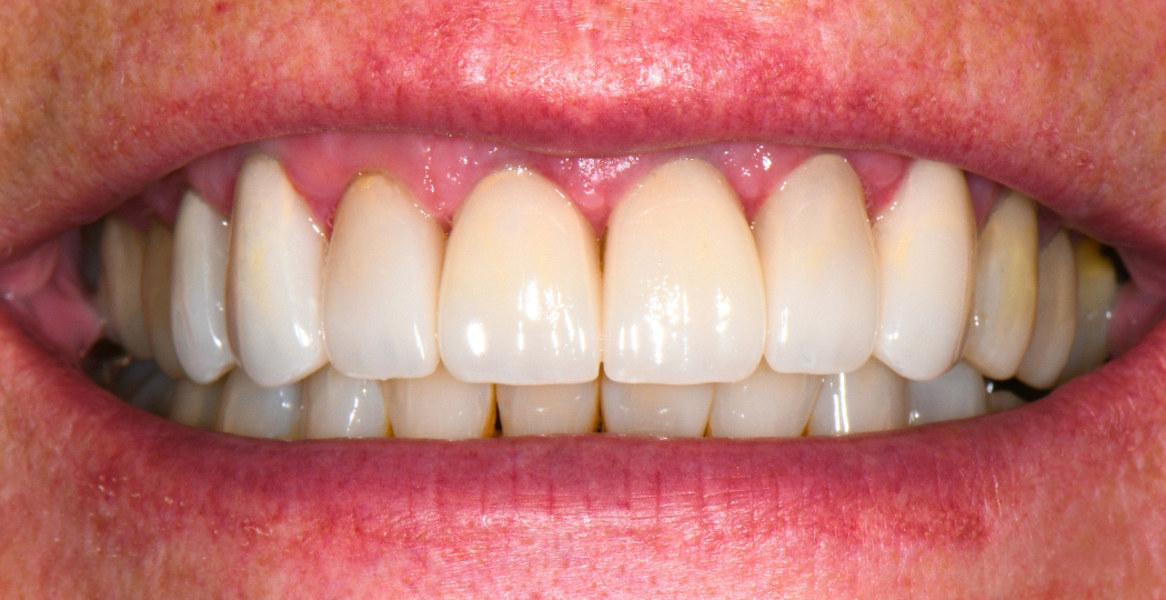 Close-up of a smile showing clean, white upper and lower teeth with healthy gums.