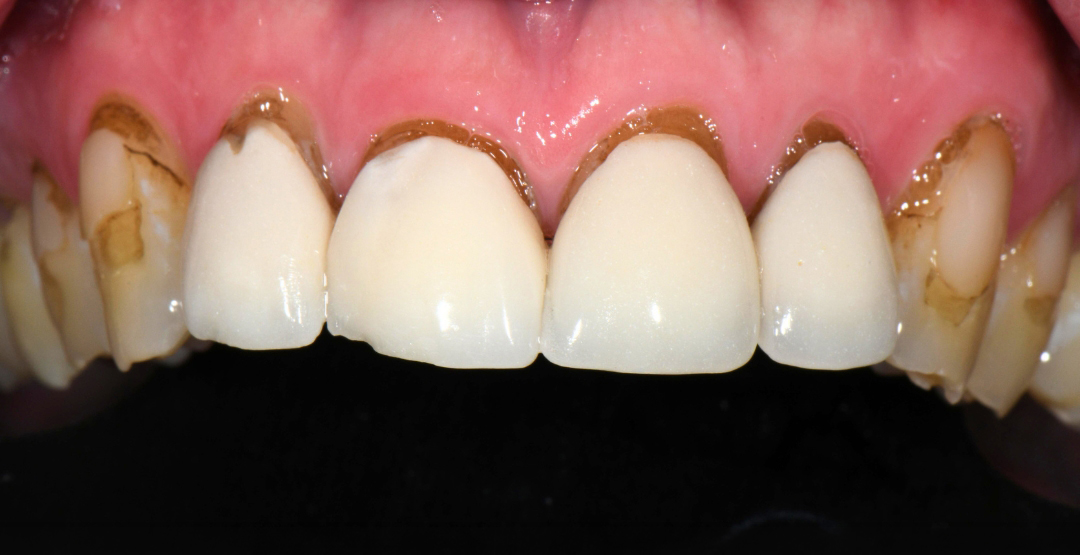 Close-up of upper front teeth stained with brown discoloration near gums and on tooth surfaces.