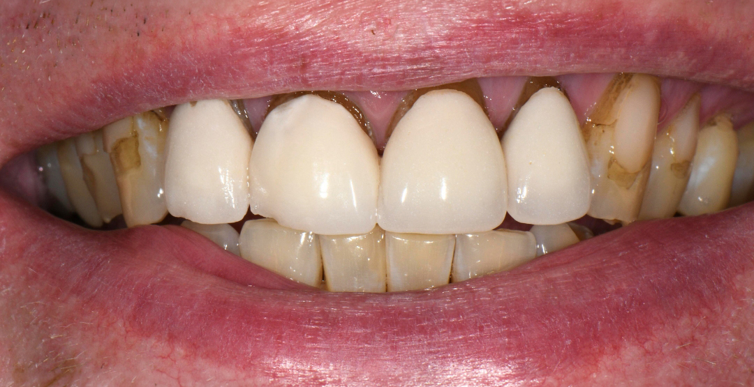 Close-up of teeth with dental crowns on upper front teeth and visible staining on other teeth.