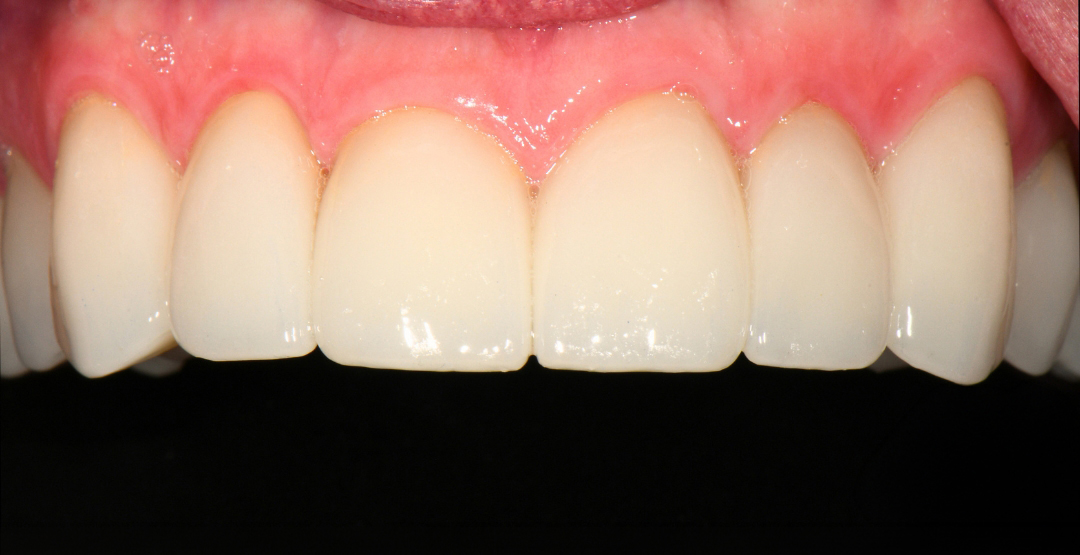 Close-up of clean, well-aligned upper front teeth and healthy pink gums against a black background.