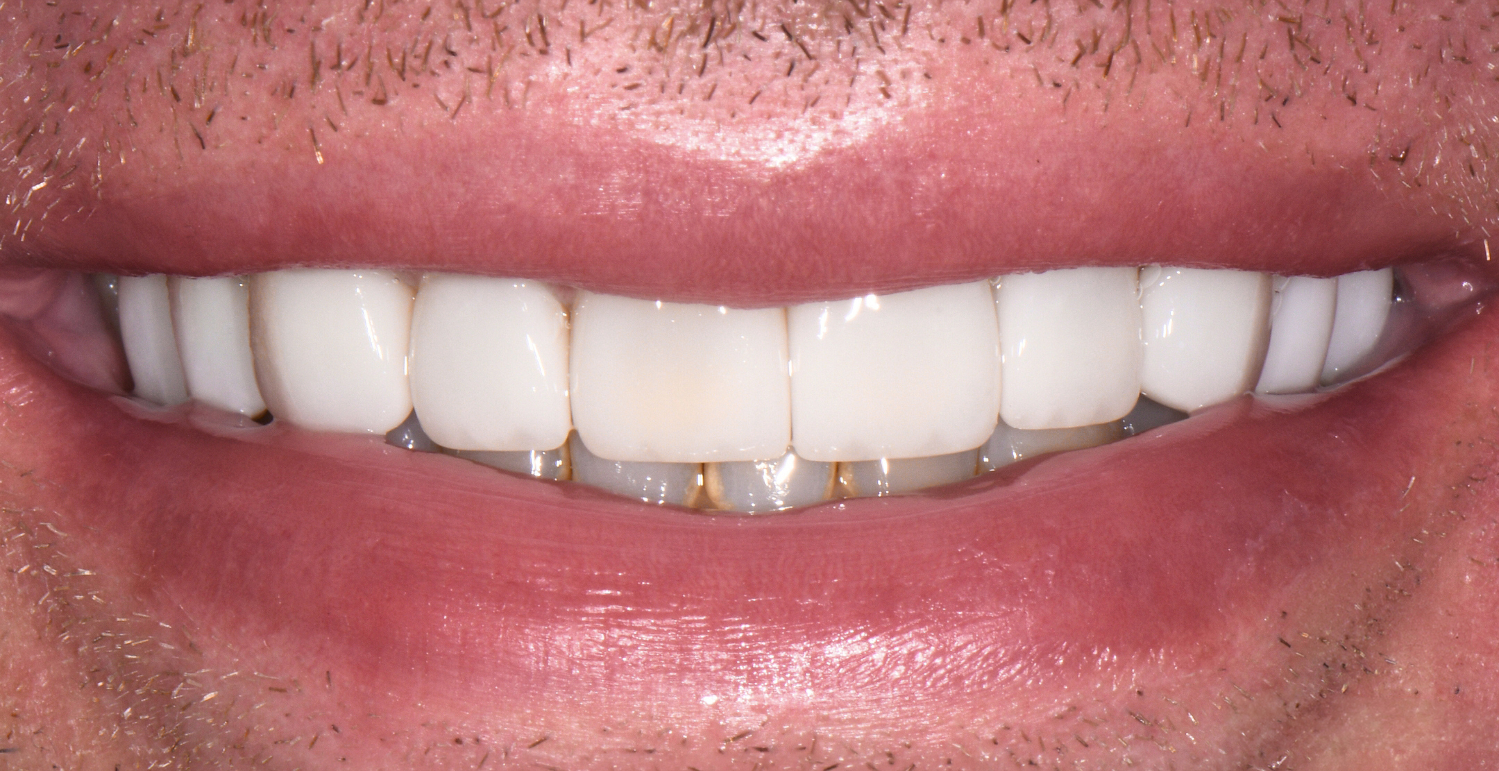 Close-up of a person's mouth smiling with clean, white, evenly spaced teeth and some facial hair.