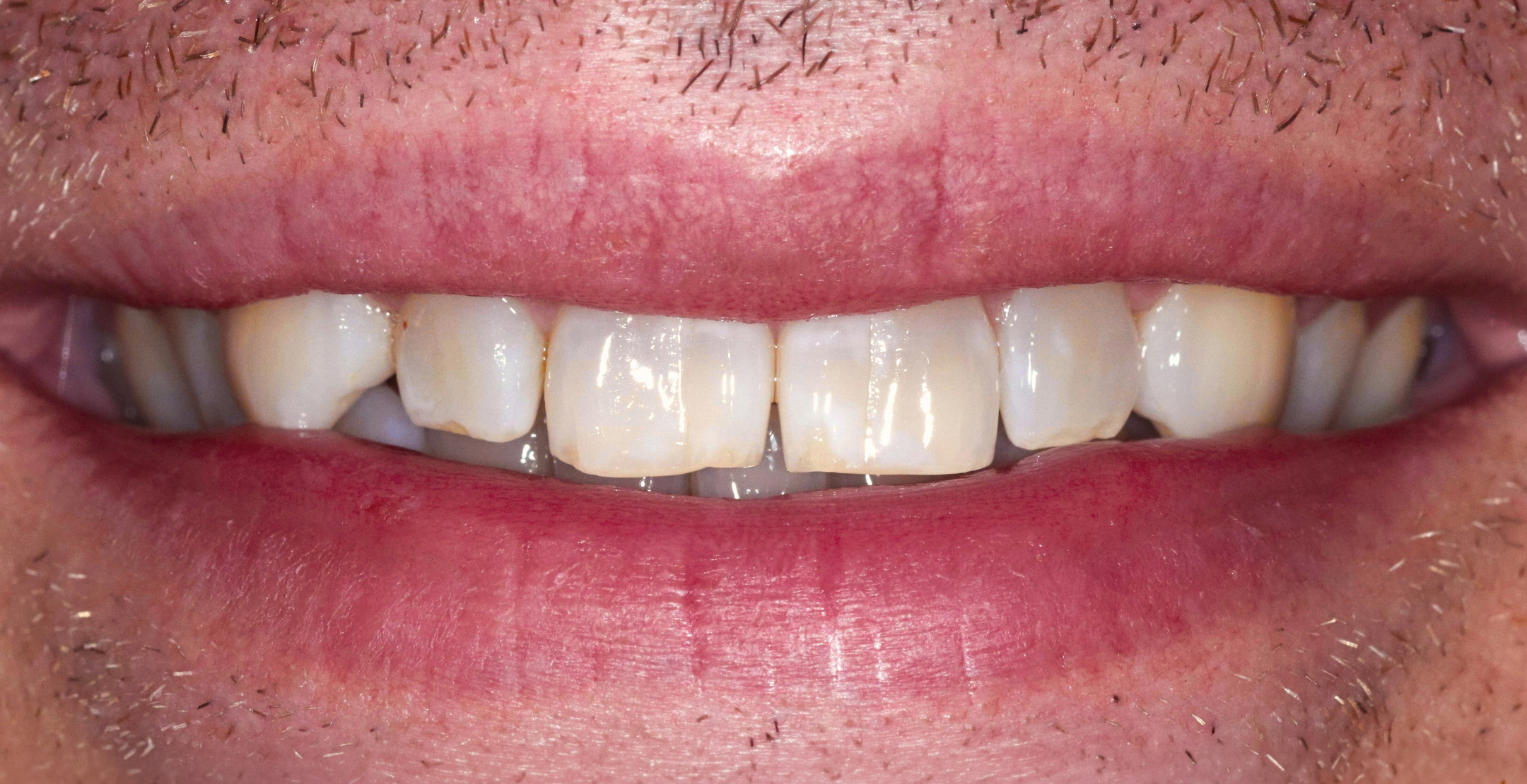 Close-up of a mouth with slightly stained and chipped upper front teeth and sparse facial hair.