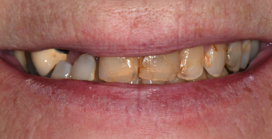 Close-up of a mouth with stained, chipped, and discolored upper front teeth and dry lips.