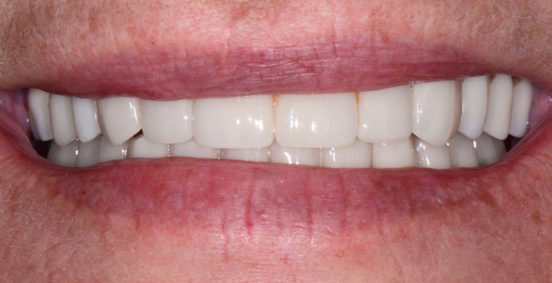 Close-up of a person's closed smile showing clean, white, evenly spaced teeth.