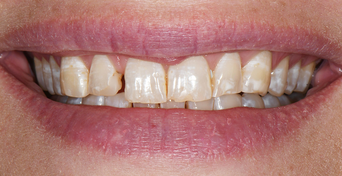 Close-up of a smile showing discolored, chipped, and uneven upper front teeth.