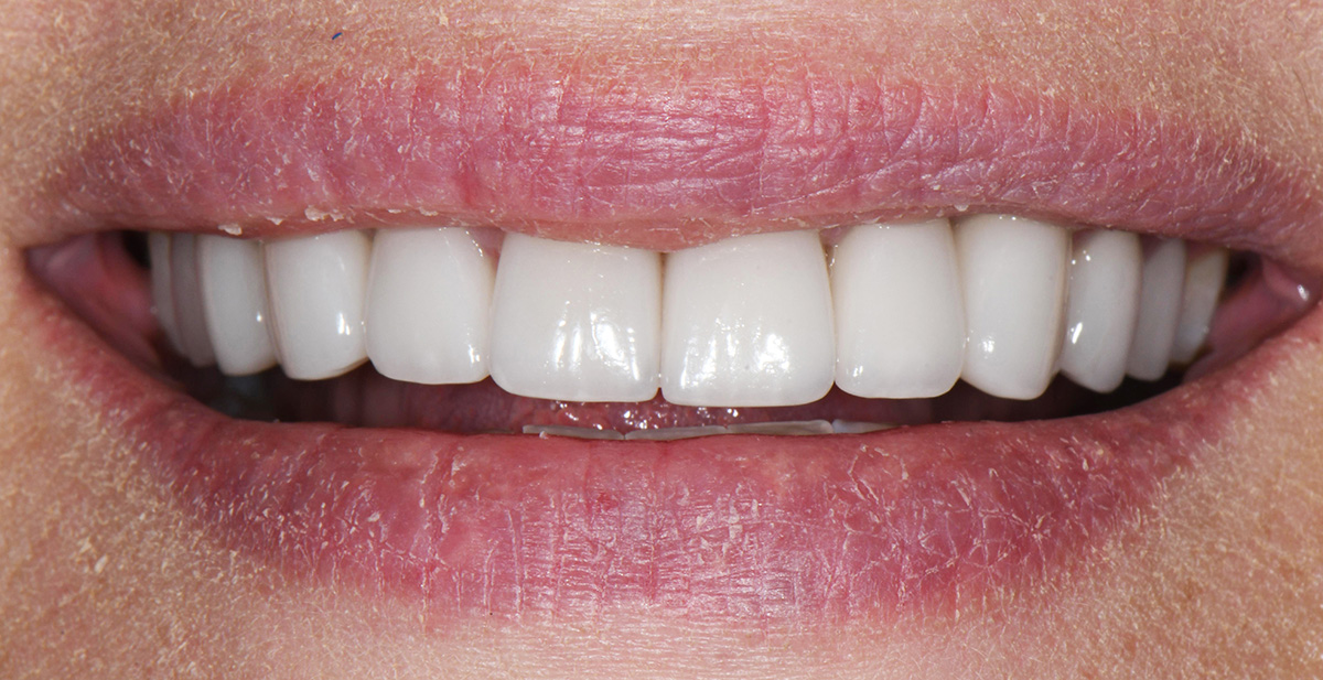 Close-up of a smile showing white, even teeth and dry, cracked lips.