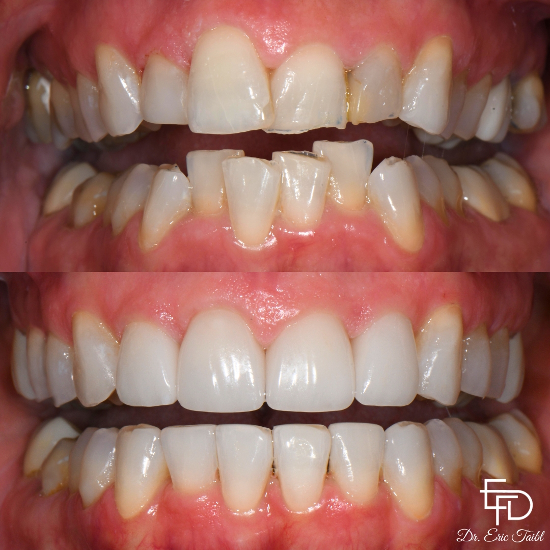 Before and after correcting significantly misaligned teeth