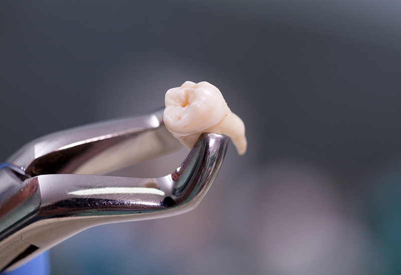 Dental clasp holding an extracted tooth