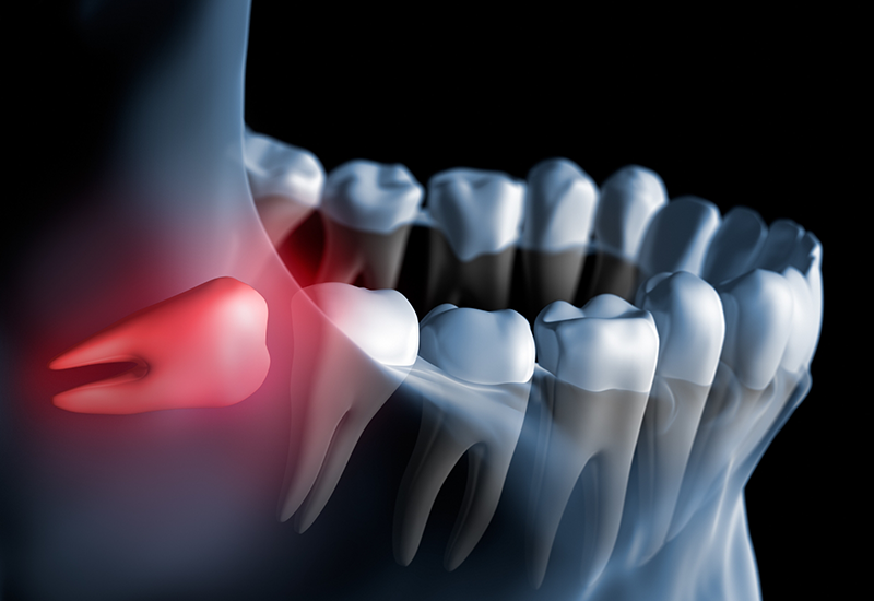 Illustration of an impacted wisdom tooth pressing against adjacent tooth