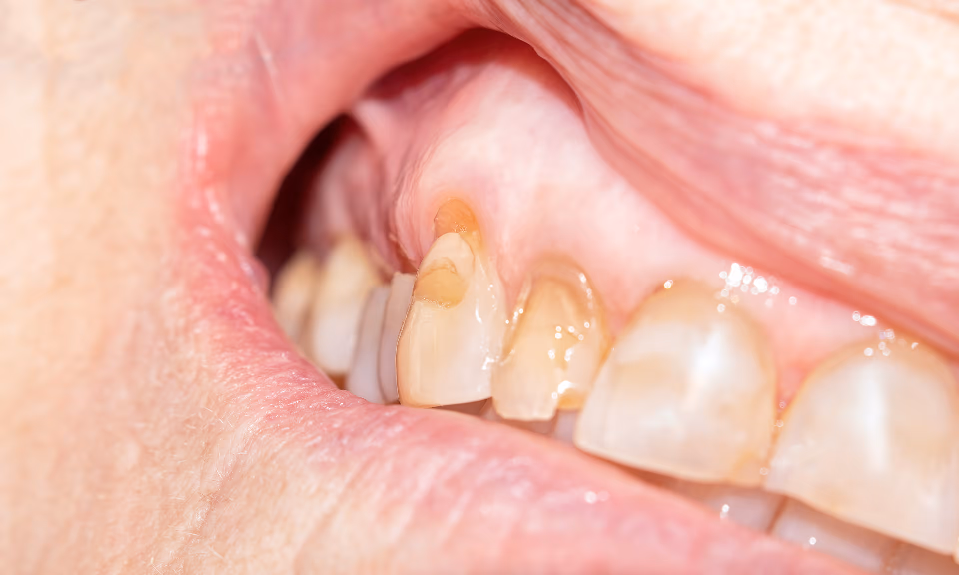 Diagram showing cracked tooth causing sensitivity