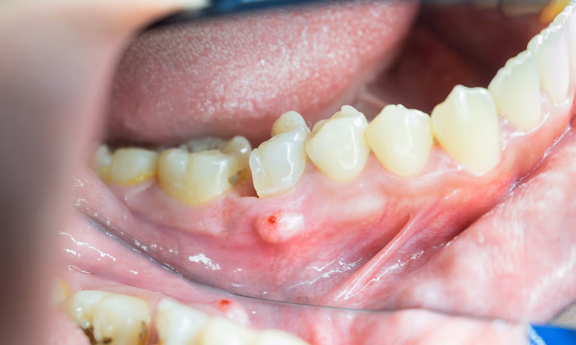 Illustration showing dental abscess with swelling near tooth root