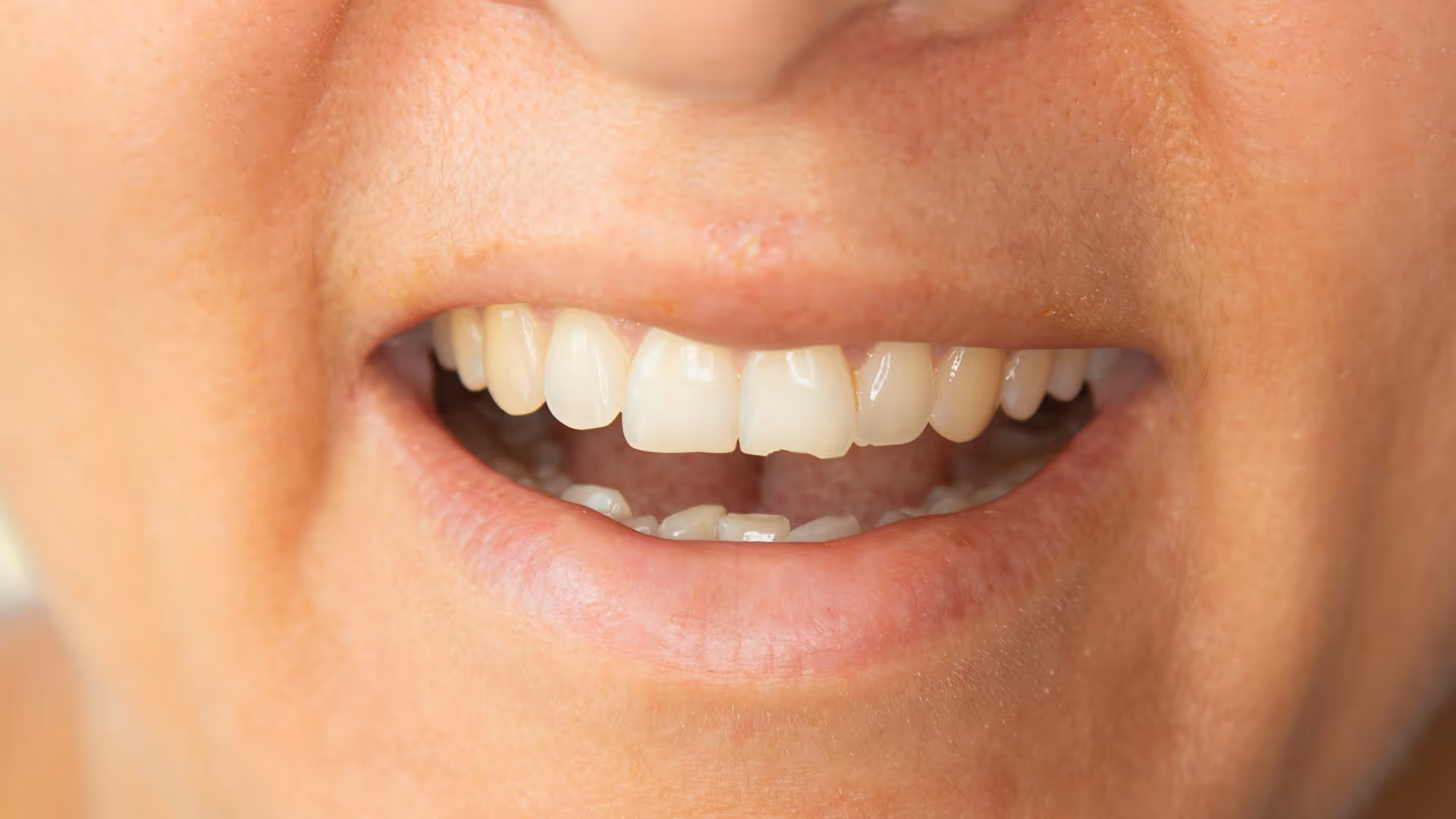 Mountain Biking Dental Trauma Tips