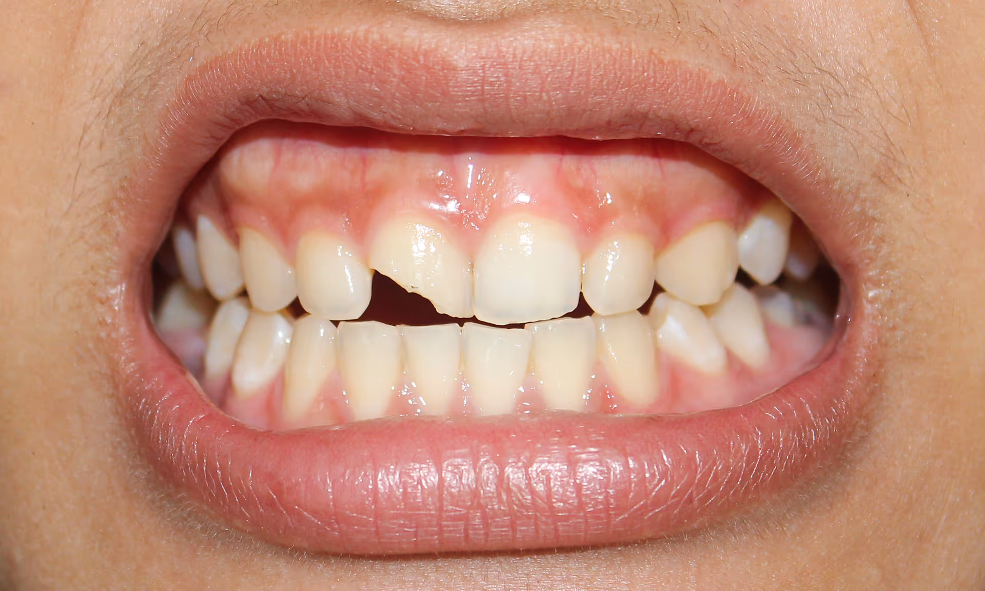 Diagram showing chipped tooth, fractured tooth, and root fracture