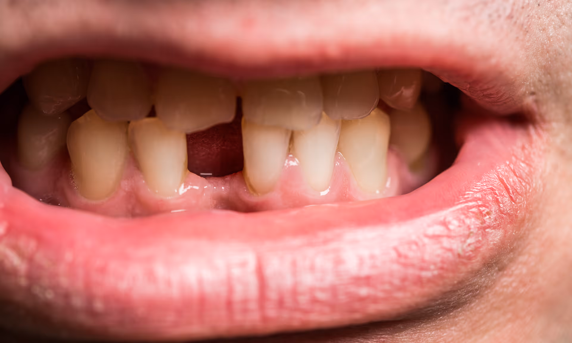 Diagram showing neighboring teeth shifting into space after tooth loss