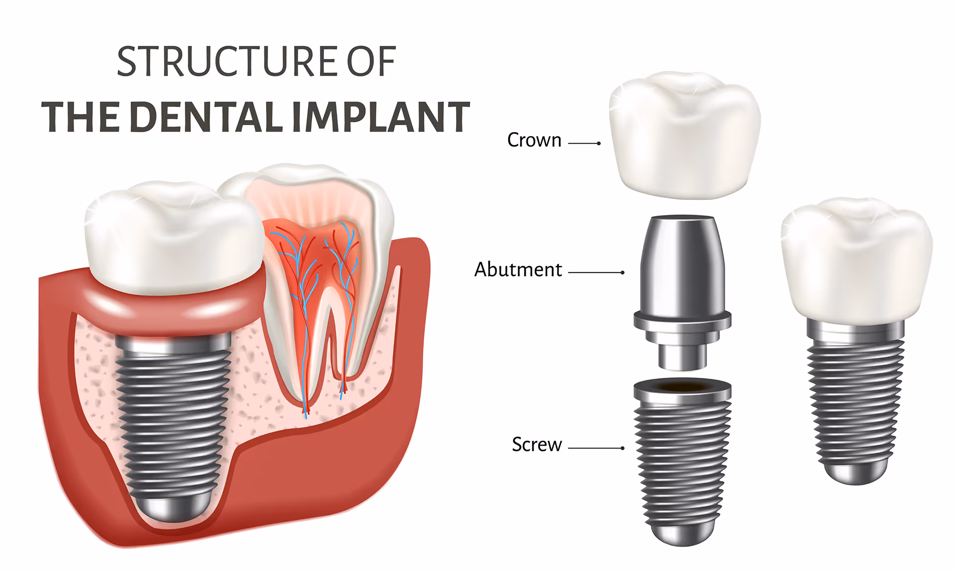 Diagram showing dental implant, abutment, and crown components