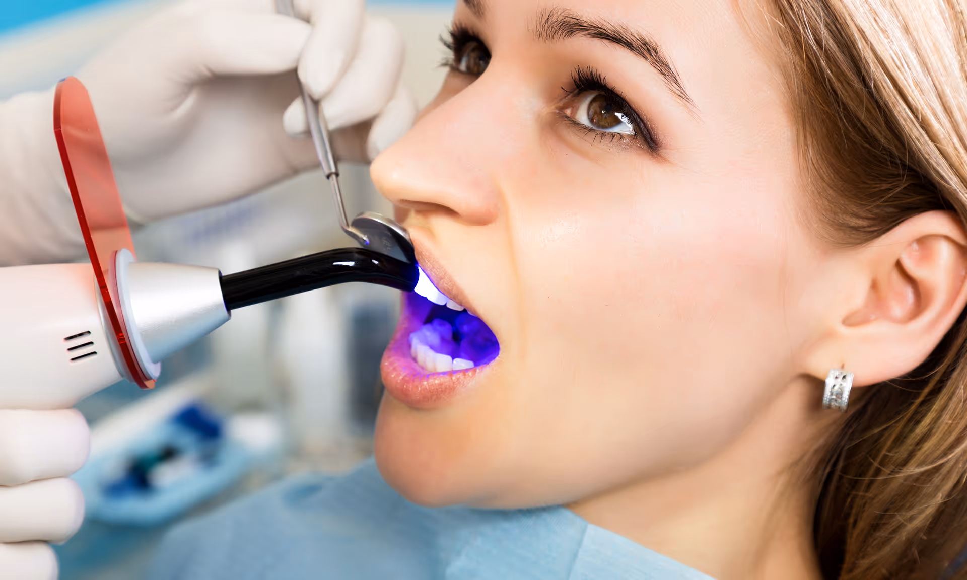 Dentist shaping composite bonding material on front tooth